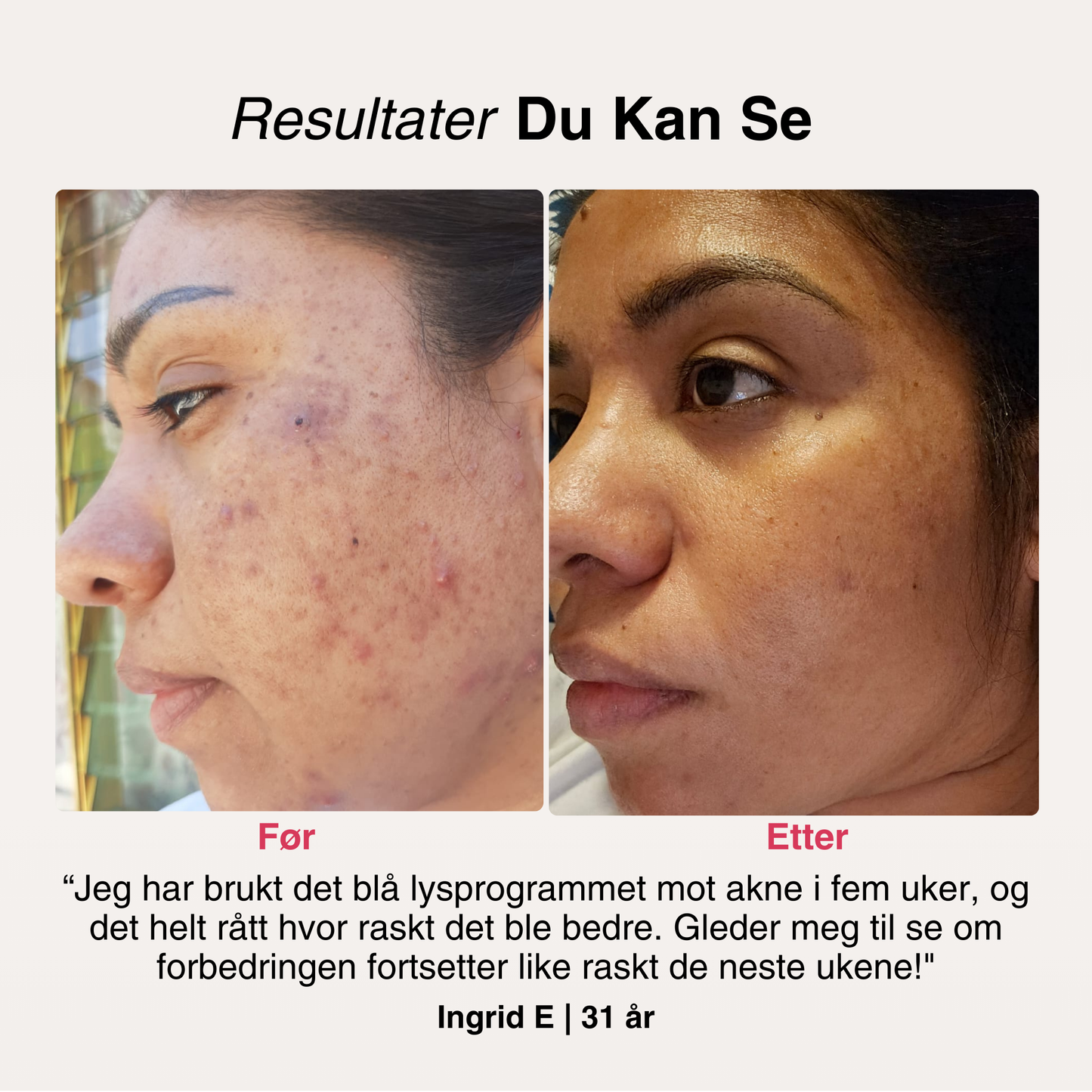 SoftSkin InfraLight® LED-maske