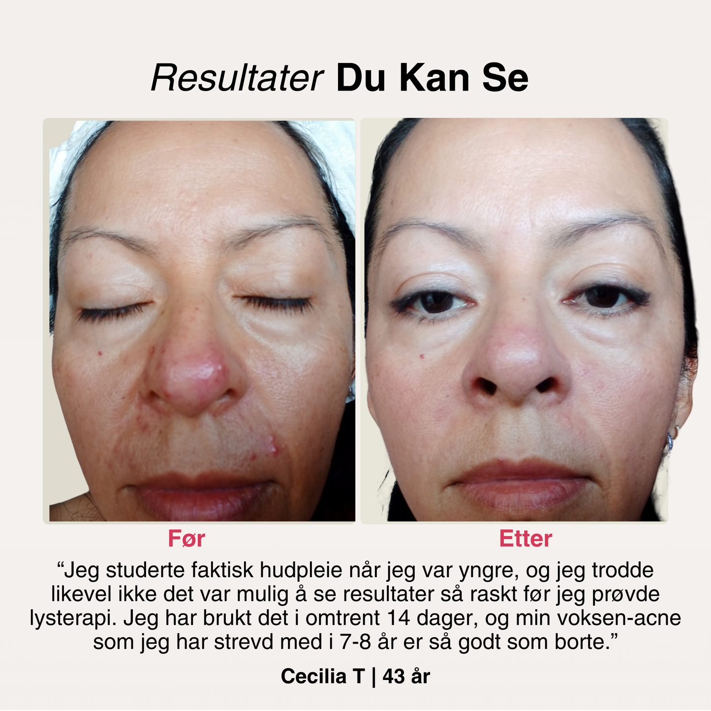 SoftSkin InfraLight® LED-maske